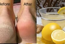 Cracked Heels Treatment